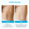 Comparison of underarm skin before and after treatment, showing improved skin tone and texture in the after image.